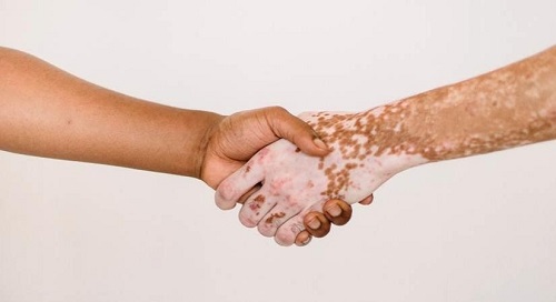 Signs to detect Vitiligo