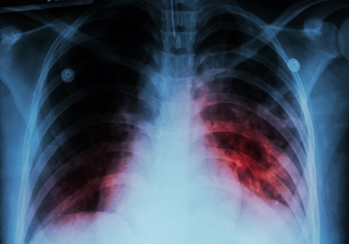 Nutritional acquired immunodeficiency is driving TB pandemic
