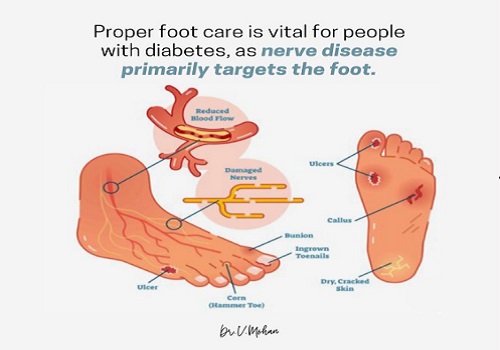 Here`s how to take care of your foot health if you have diabetes